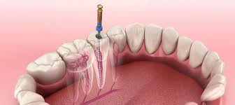 How a Sugar Land Dentist Makes Root Canals Easy and Stress-Free