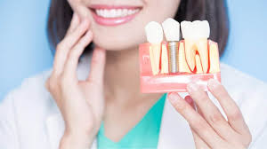 3 Key Advantages Of Combining Family And Implant Dentistry