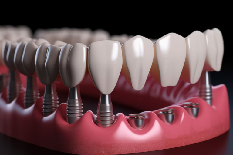 Why Implants Improve Confidence Beyond Tooth Replacement