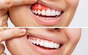 The Role Of Periodontists In Preparing For Successful Implants